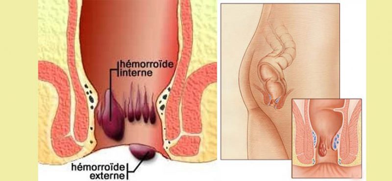 hémoroïde 1